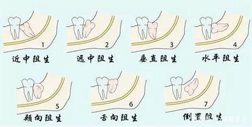 發(fā)炎的智齒什么時(shí)候拔才好？有些情況不能拔