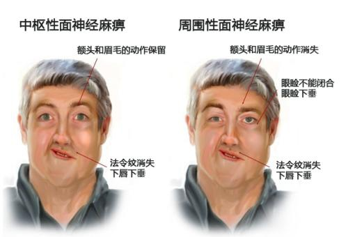 “面癱”不僅不酷，并且需要治療