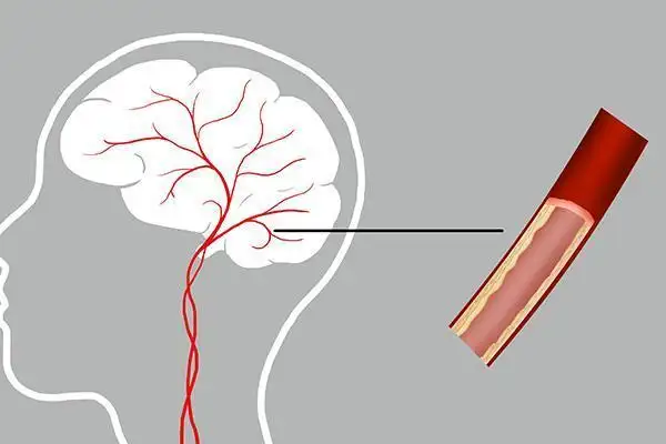 提醒中老年人：腦供血不足時(shí)，身體會(huì)發(fā)出4個(gè)信號(hào)！該如何治療？