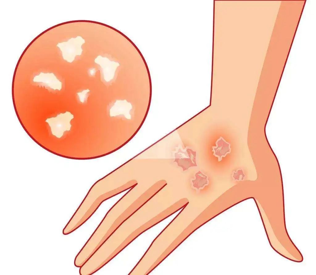 開在皮膚上的“花”？謹(jǐn)防春季玫瑰糠疹