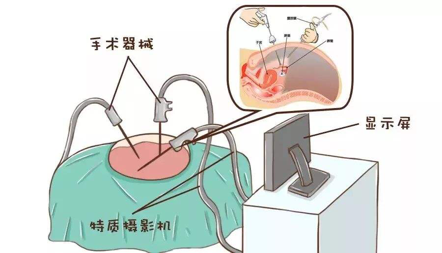 11歲女孩急性腹痛！竟然是卵巢囊腫蒂扭轉了