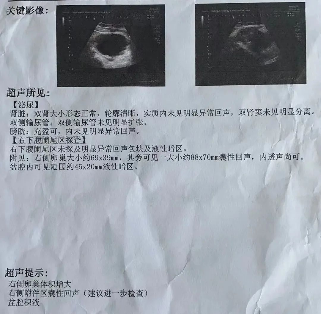 11歲女孩急性腹痛！竟然是卵巢囊腫蒂扭轉了
