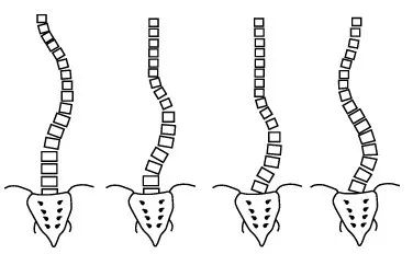 脊柱側(cè)彎如何康復(fù)？河南省中醫(yī)院西區(qū)醫(yī)院專家這樣說(shuō)