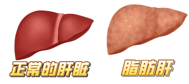健康科普 從脂肪肝到肝癌的預(yù)防，這些肝臟疾病風(fēng)險(xiǎn)篩查一定要做哦！