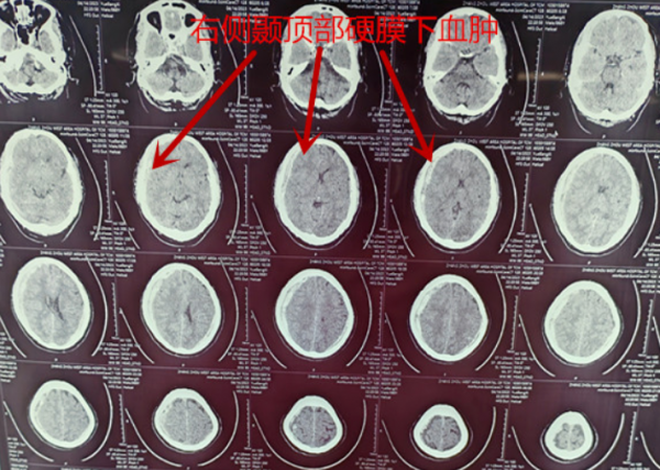 星夜拯救！神經(jīng)外科專家3小時(shí)接力，解除生命危機(jī)！