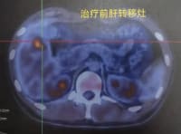 年輕小伙癌癥晚期！這些習(xí)慣不少人有，醫(yī)生：別忽視——