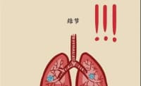 2 毫米肺結(jié)節(jié) 3 年后變肺癌！醫(yī)生提醒：這 2 種肺結(jié)節(jié)一定要當(dāng)心！