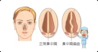 90%的人都患有鼻中隔偏曲，什么情況下需要手術(shù)？