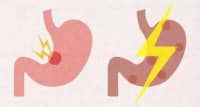 出現(xiàn)多食、易饑等情況？要及時(shí)進(jìn)行這3種原發(fā)病的篩查