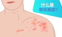 這種病不致命，疼起來卻要人命！關(guān)注帶狀皰疹，及早預(yù)防……