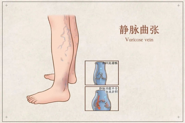 攝圖網(wǎng)_401799108_banner_靜脈曲張醫(yī)療插畫(huà)(企業(yè)商用).jpg 3-tuya.jpg
